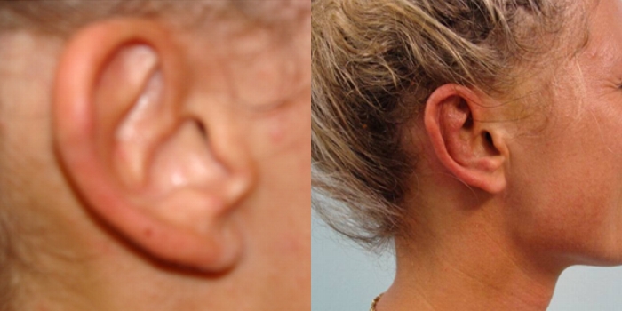 Otoplastika,  nakon 7 dana